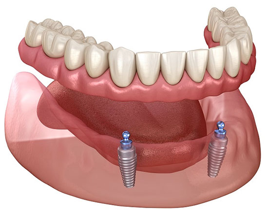 Implant Overdentures in Richmond, TX - Haven Dentistry