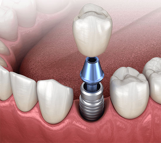 Implant, Abutment and Implant Crown