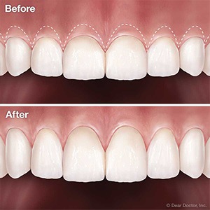Cosmetic Crown Lengthening in Richmond, TX - Haven Dentistry