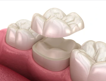 Ceramic Dental Crowns in Richmond, TX - Haven Dentistry