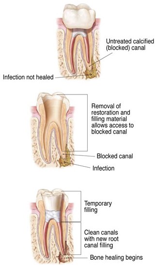 Root Canal Retreatment in Richmond, TX - Haven Dentistry