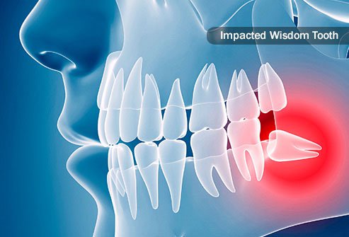 Wisdom Tooth Extractions in Richmond, TX - Haven Dentistry