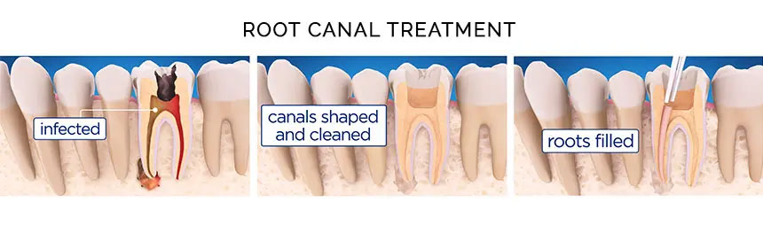 Root Canal Therapy in Richmond, TX - Haven Dentistry