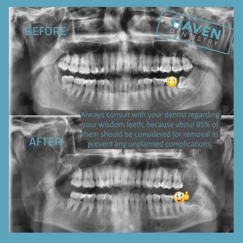 Dental X-Ray for Wisdom Teeth Removal Richmond TX