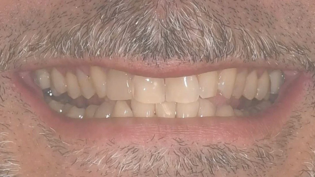 before image duchenne