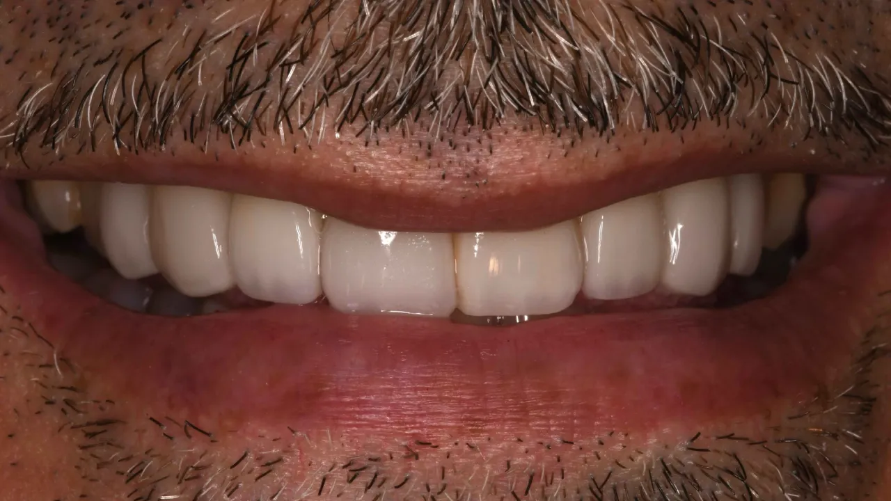 after veneers image duchenne